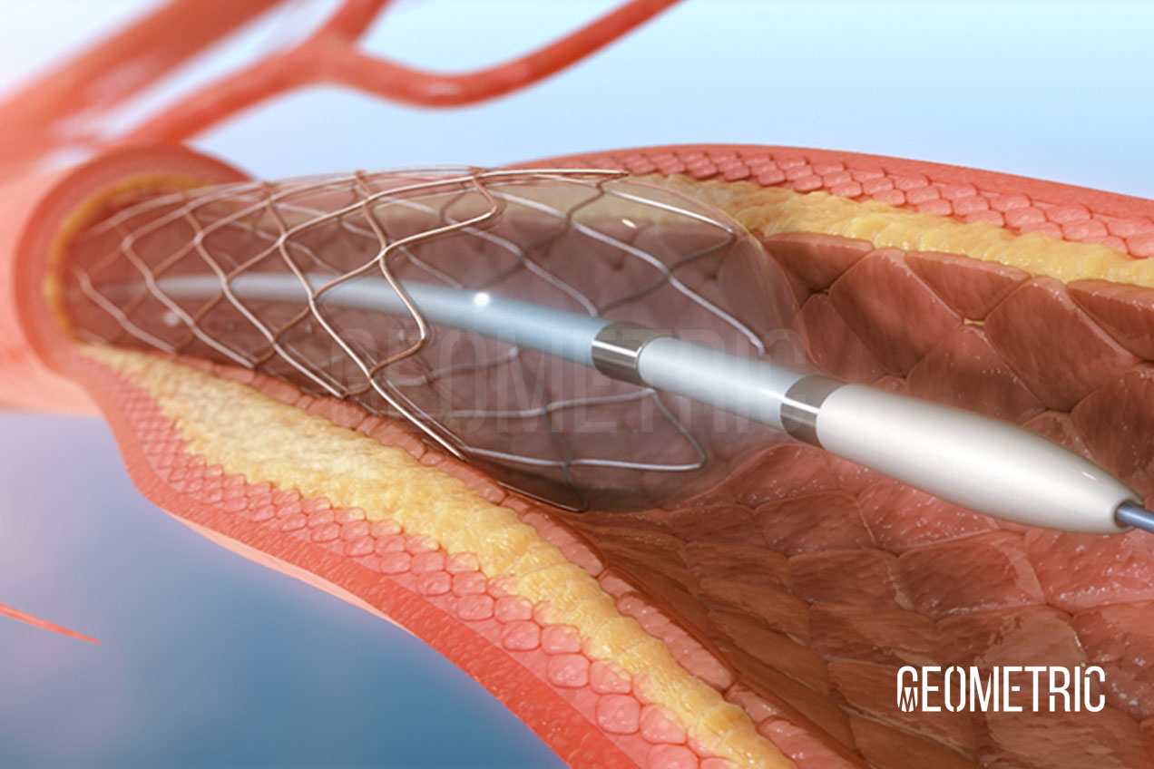 Angioplasty Medical Illustration | Geometric Medical Animation