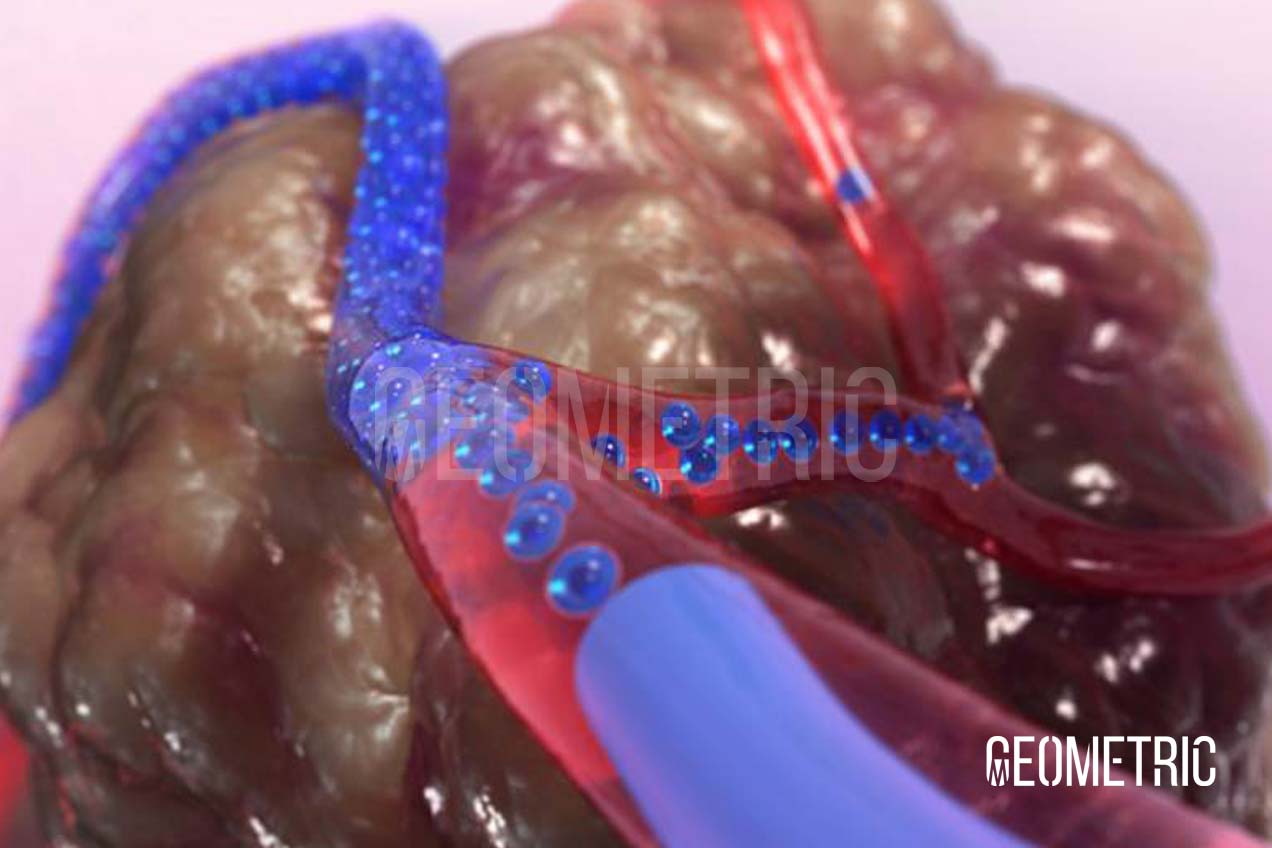 Embolization Animation